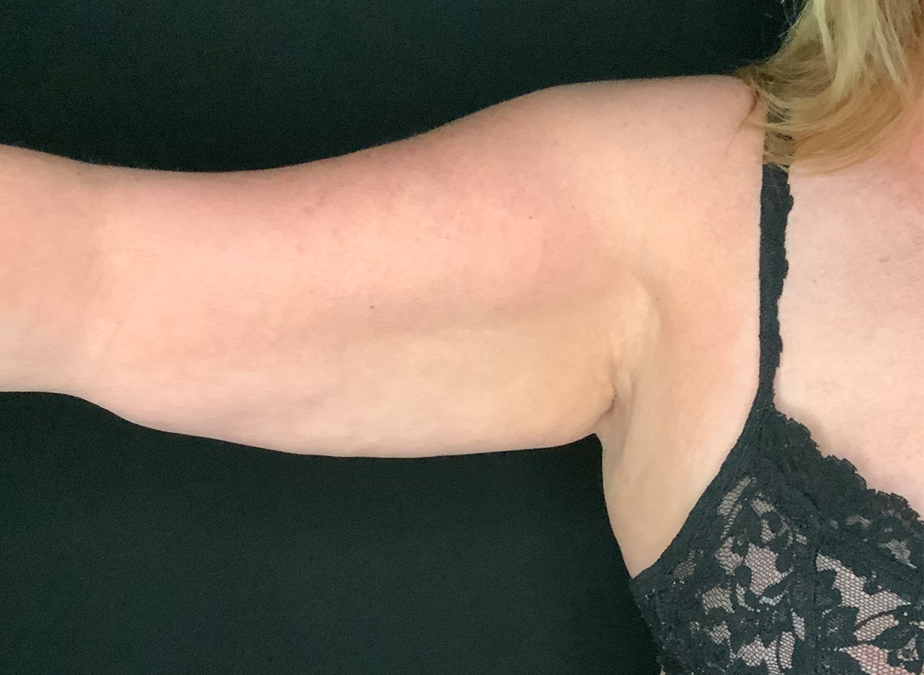 Patient #74261: BodyTite Before Image