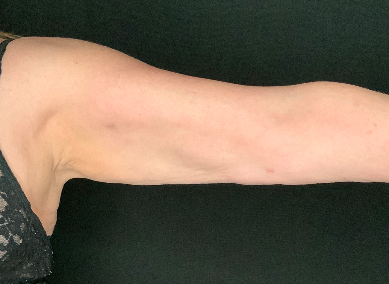 Patient #74261: BodyTite After Image