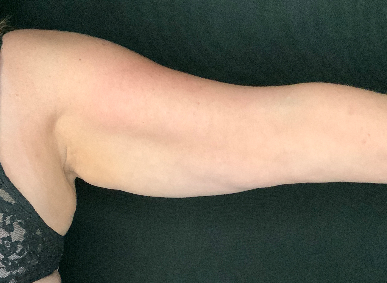 Patient #74261: BodyTite Before Image