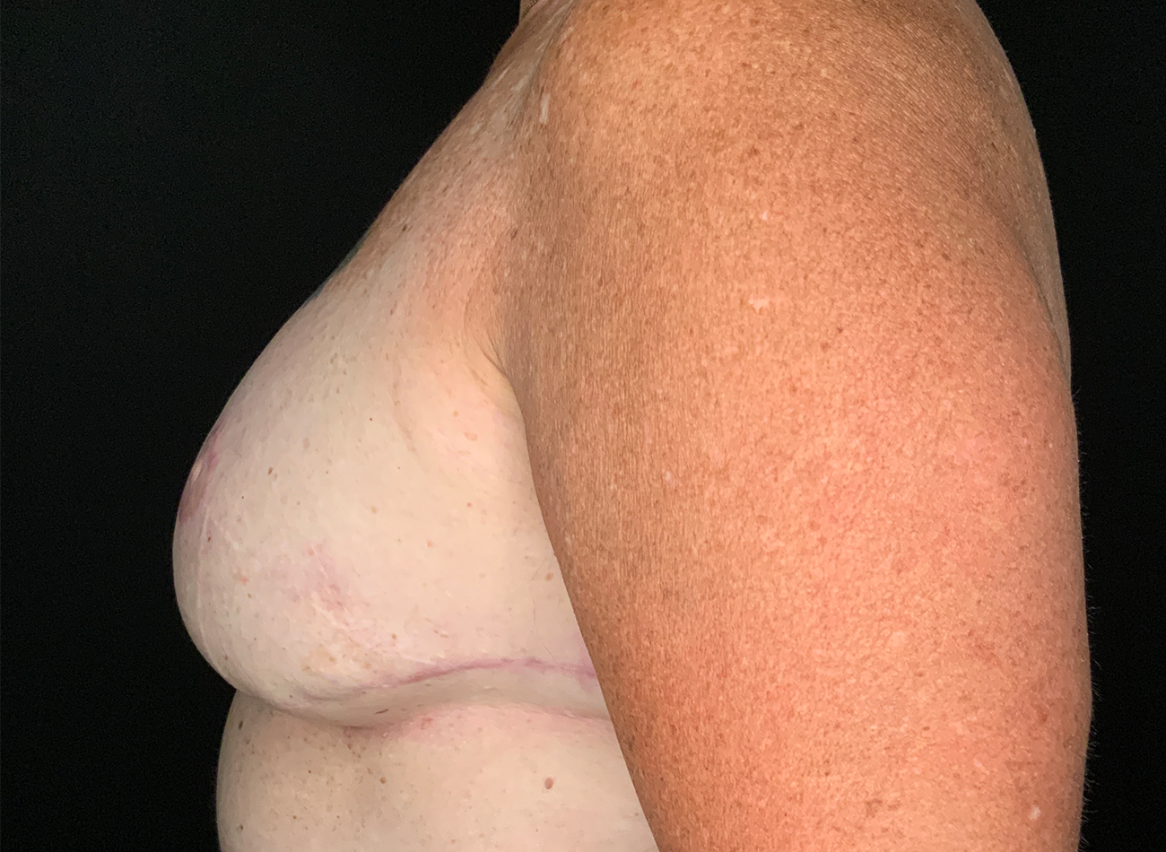 Paciente n.° 24857: Imagen posterior a la reconstrucción mamaria