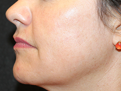 Patient #86777: Chemical Peel After Image