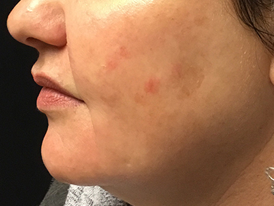 Patient #86777: Chemical Peel Before Image