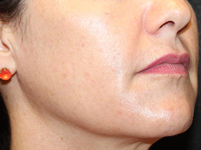 Patient #86777: Chemical Peel After Image