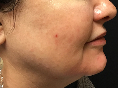 Patient #86777: Chemical Peel Before Image