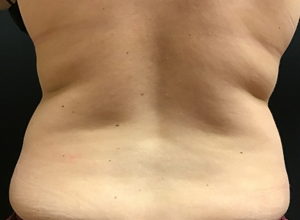 Patient #42811: CoolSculpting® After Image