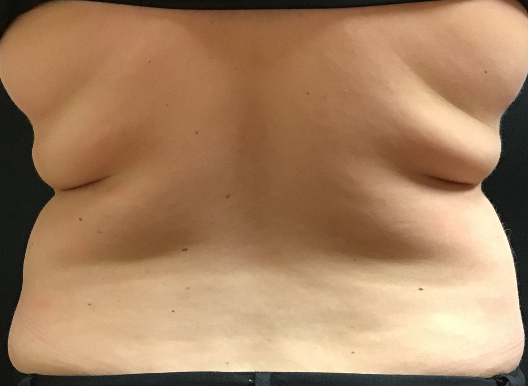 Patient #42811: CoolSculpting® Before Image
