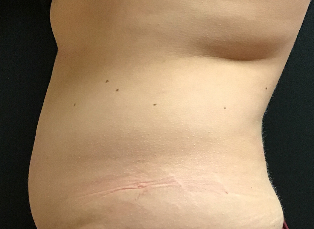 Patient #42811: CoolSculpting® After Image