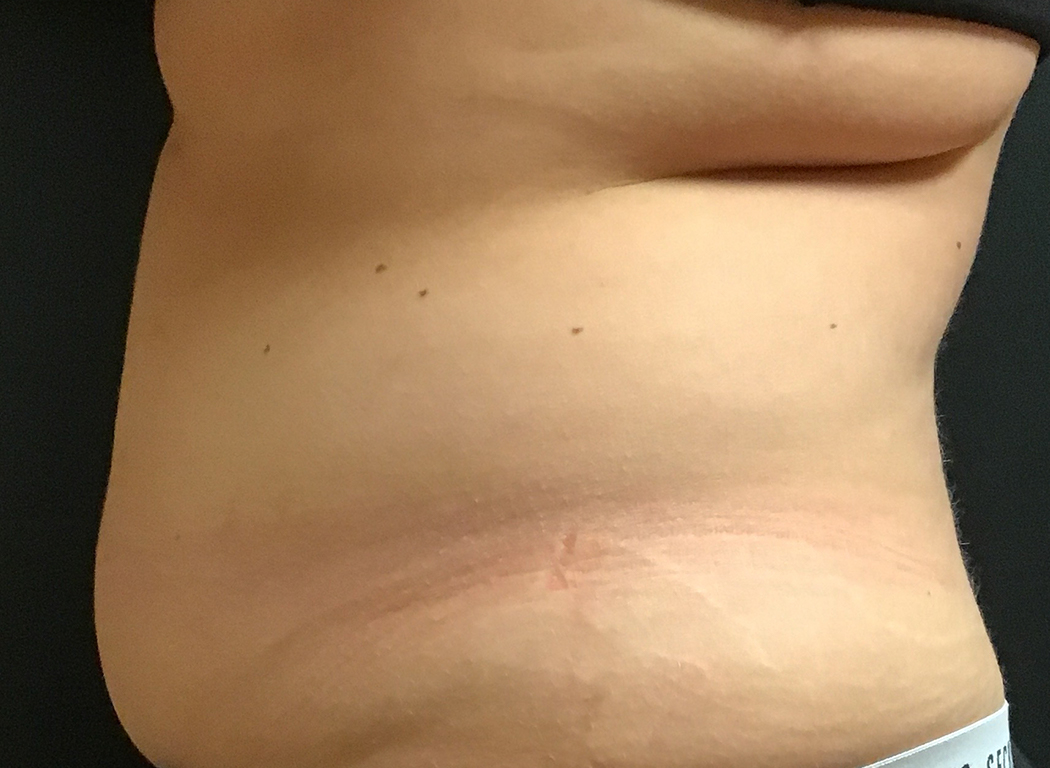 Patient #42811: CoolSculpting® Before Image