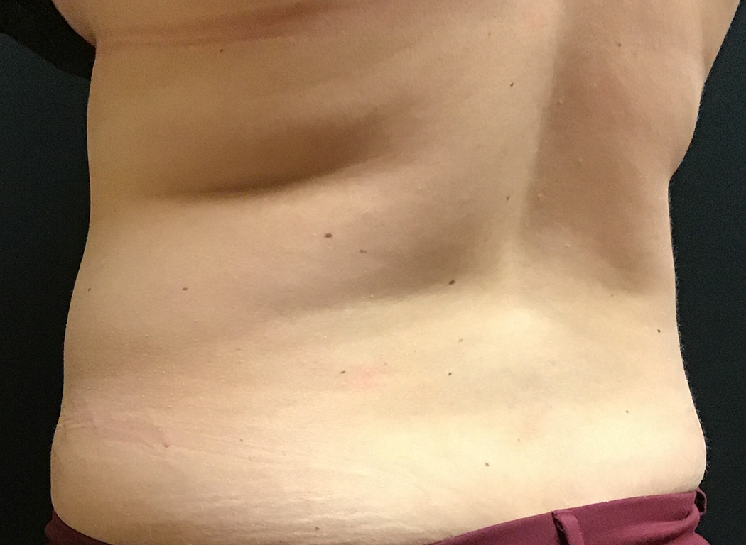 Patient #42811: CoolSculpting® After Image