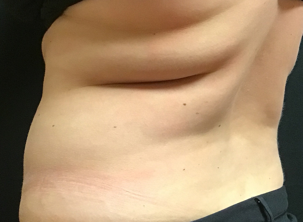 Patient #42811: CoolSculpting® Before Image