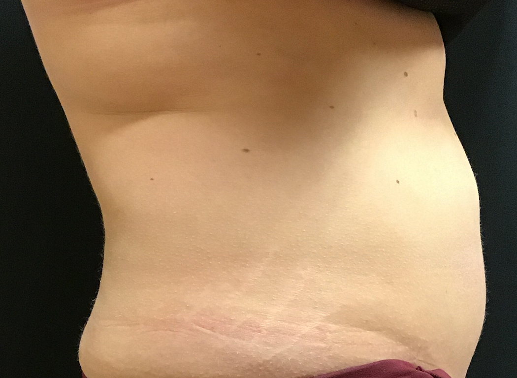 Patient #42811: CoolSculpting® After Image