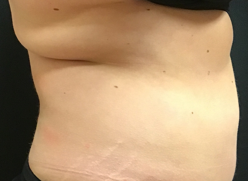 Patient #42811: CoolSculpting® Before Image