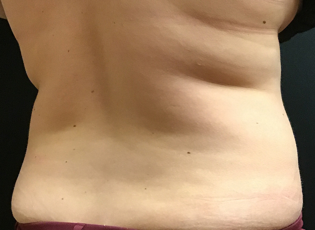 Patient #42811: CoolSculpting® After Image