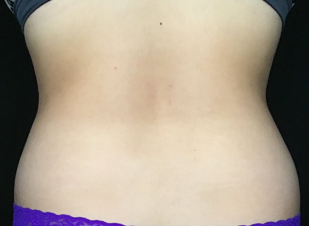 Patient #39678: CoolSculpting® After Image
