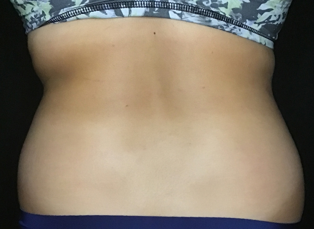 Patient #39678: CoolSculpting® Before Image