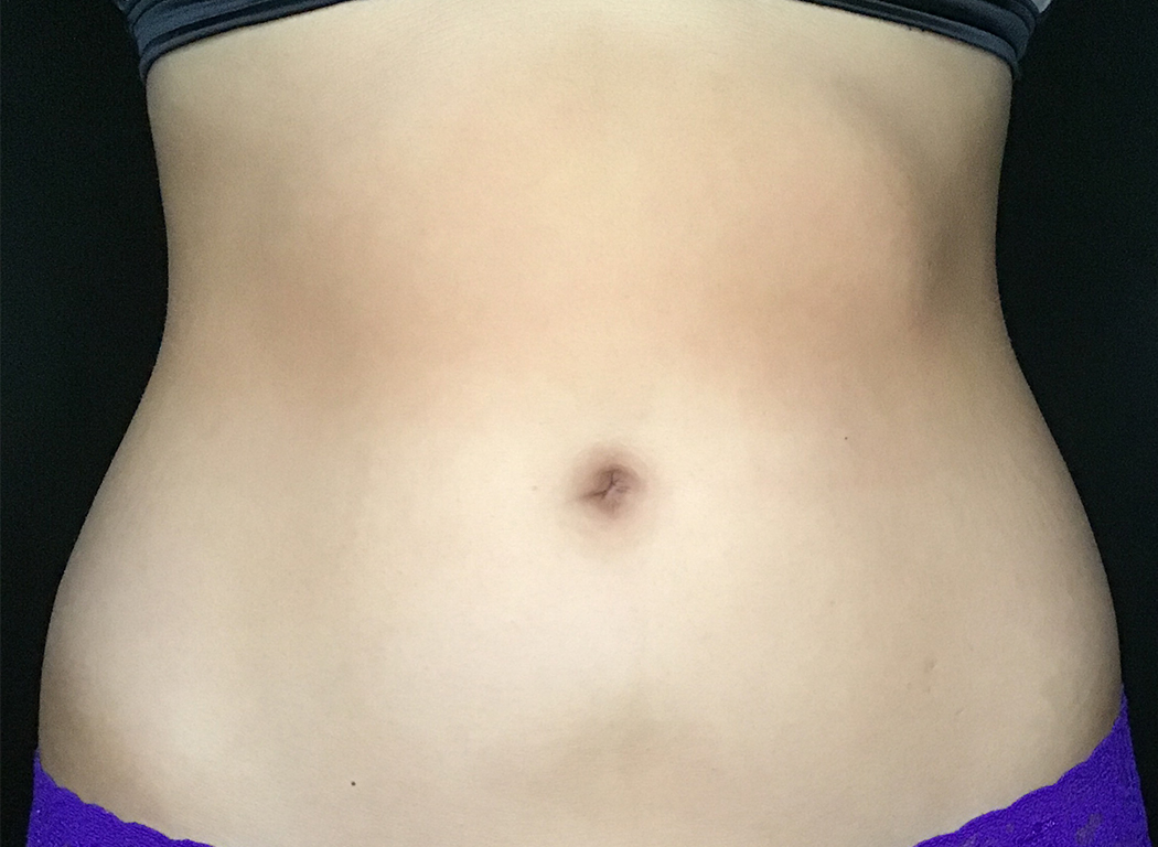 Patient #39678: CoolSculpting® After Image
