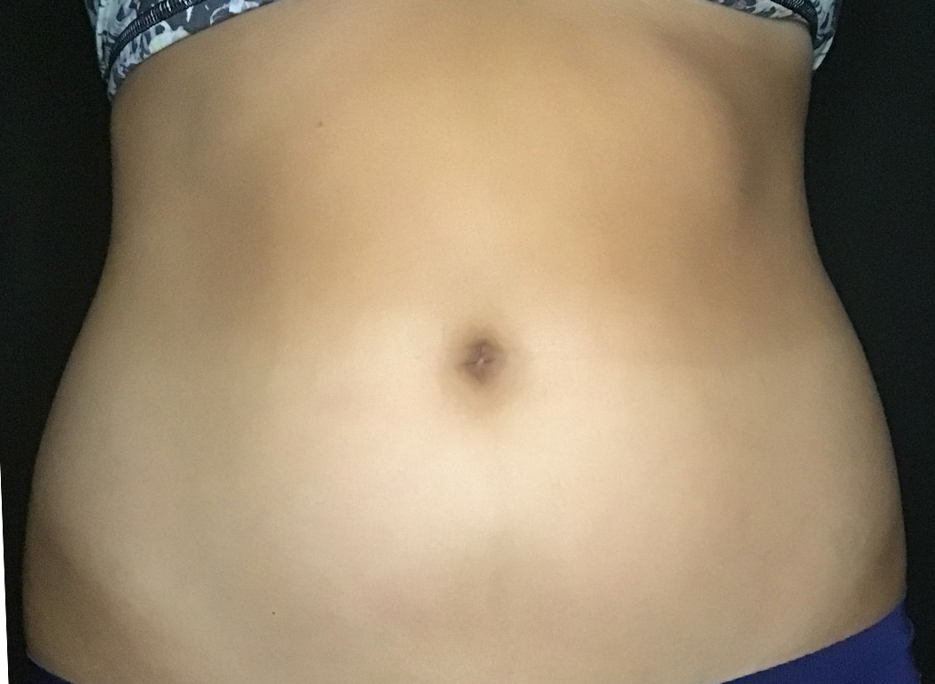 Patient #39678: CoolSculpting® Before Image