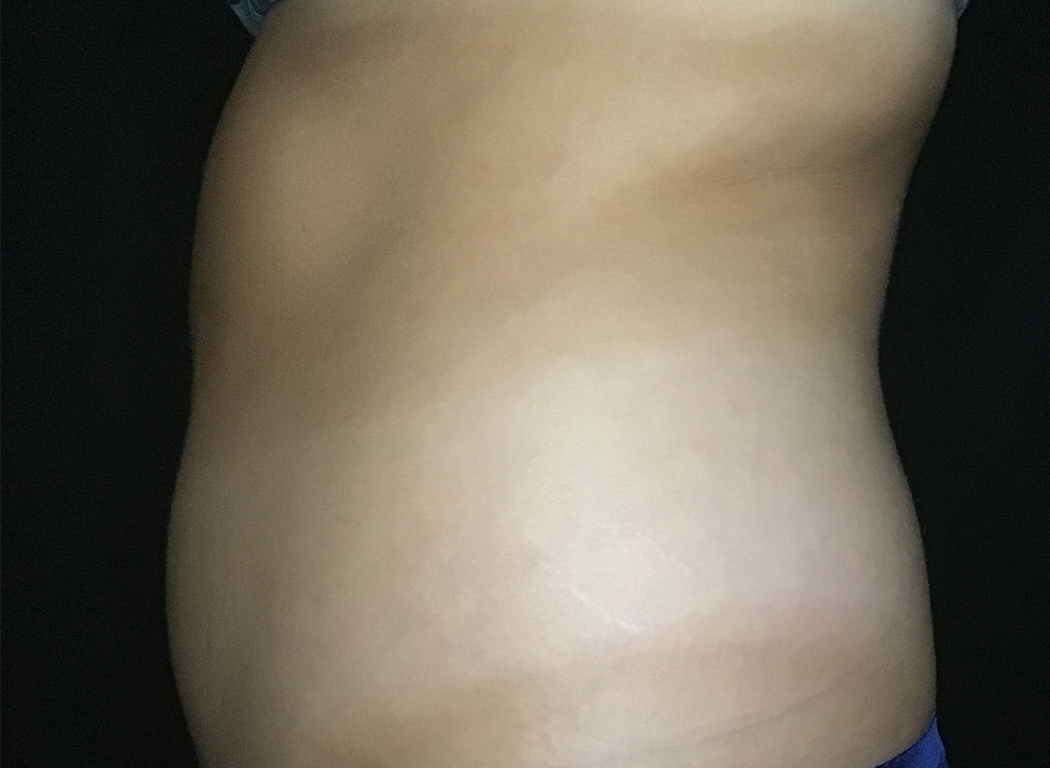 Patient #39678: CoolSculpting® Before Image