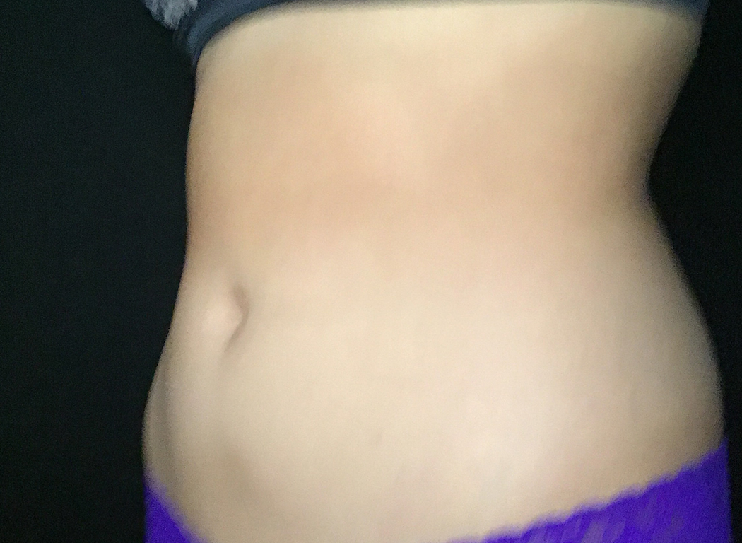 Patient #39678: CoolSculpting® After Image