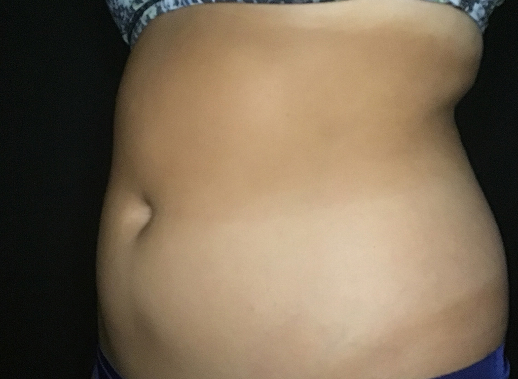 Patient #39678: CoolSculpting® Before Image