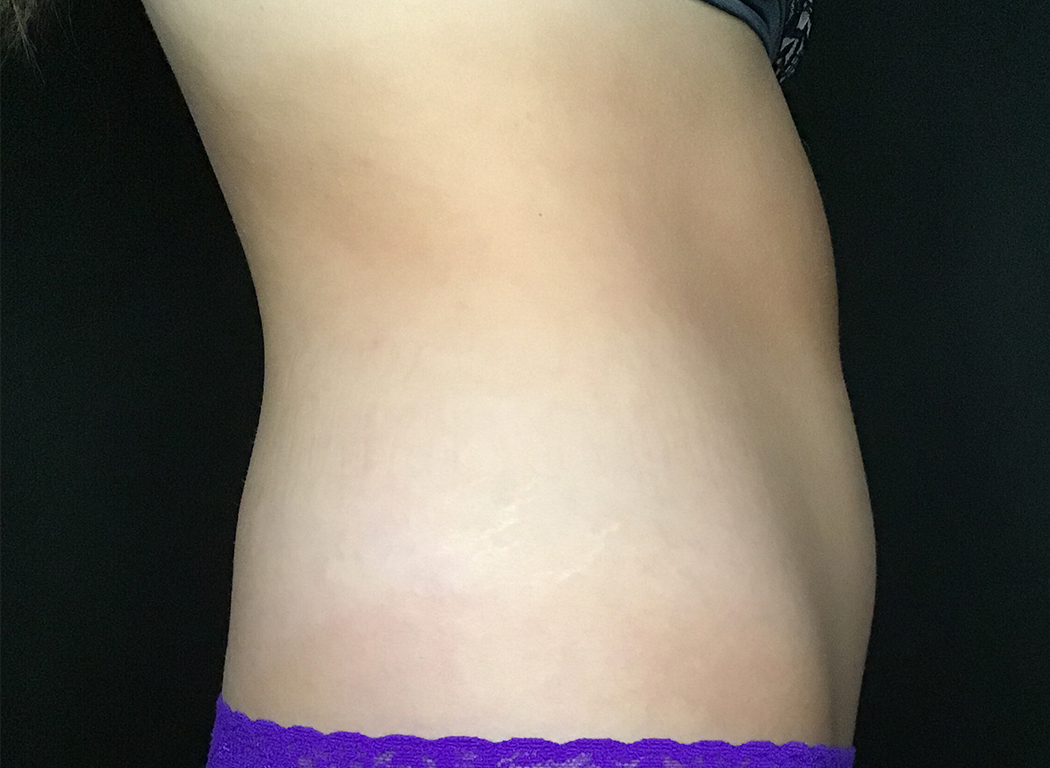 Patient #39678: CoolSculpting® After Image