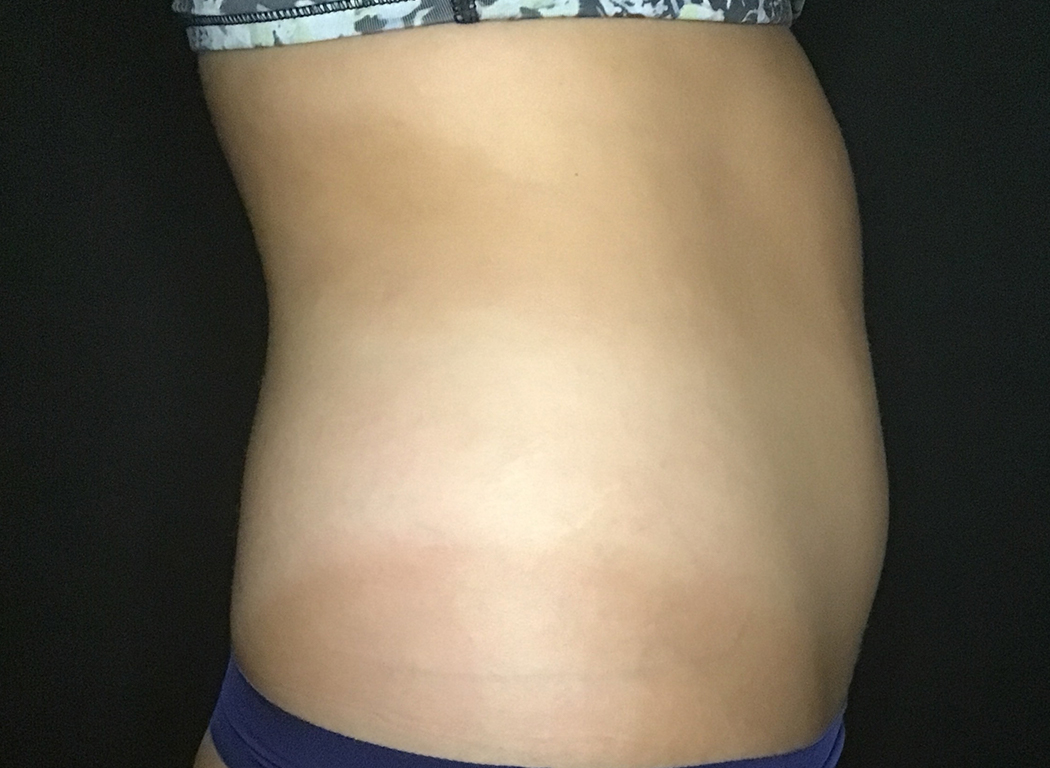 Patient #39678: CoolSculpting® Before Image