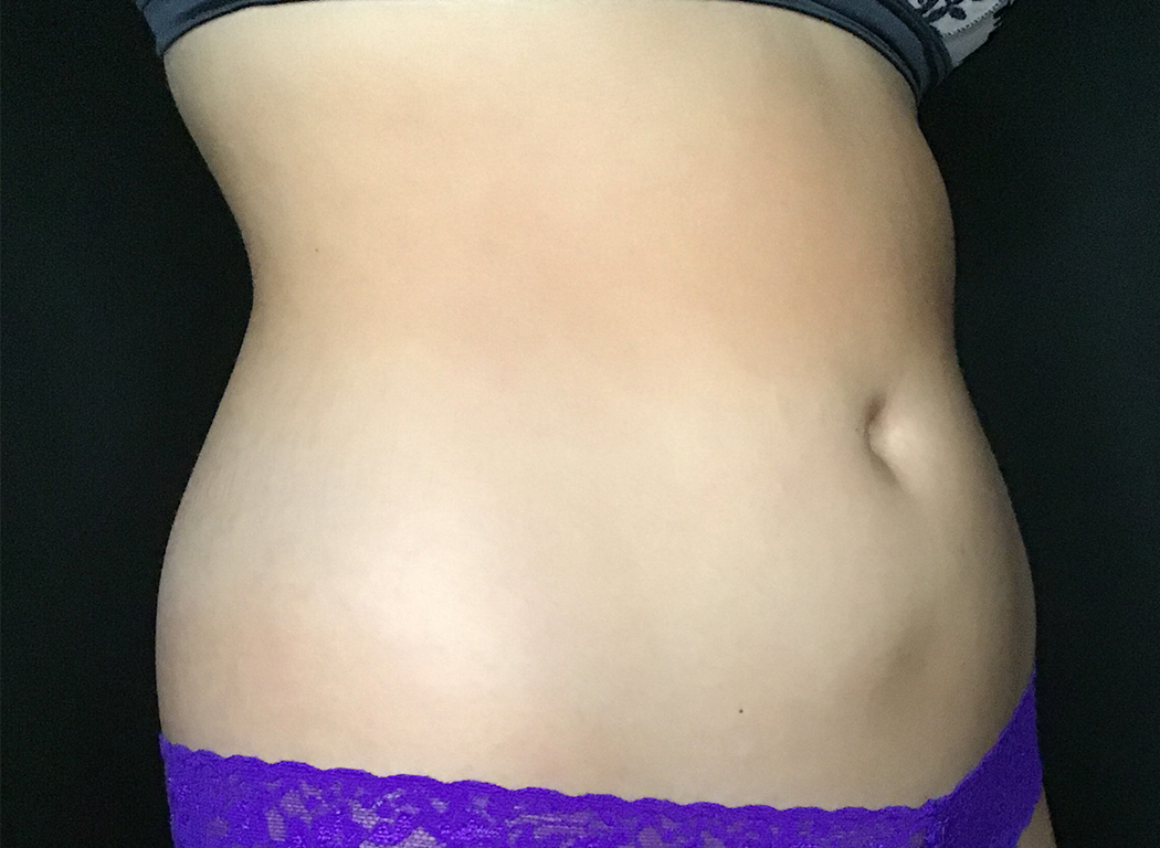 Patient #39678: CoolSculpting® After Image