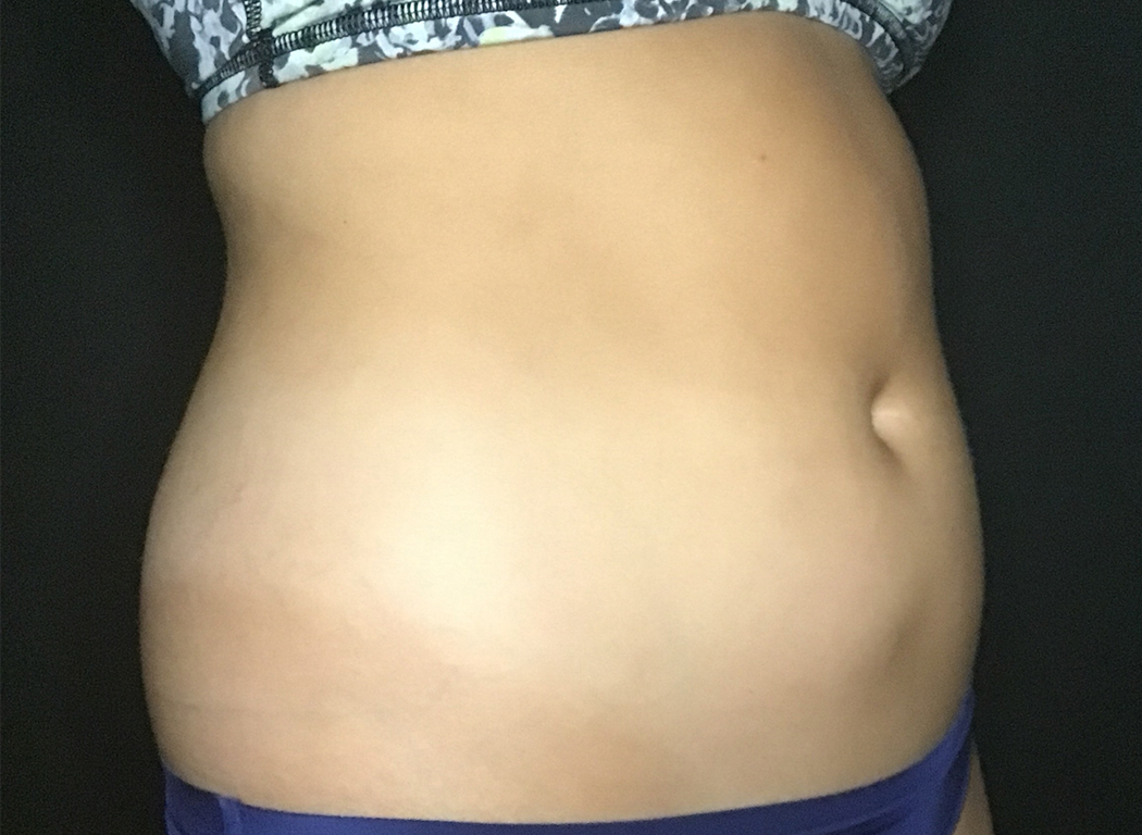 Patient #39678: CoolSculpting® Before Image