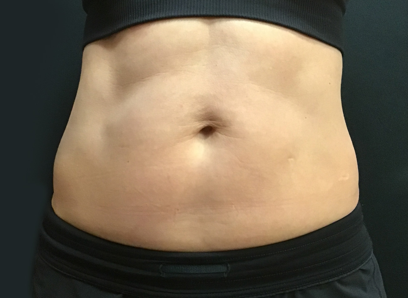 Patient #38810: EVOLVE for Skin Tightening After Image