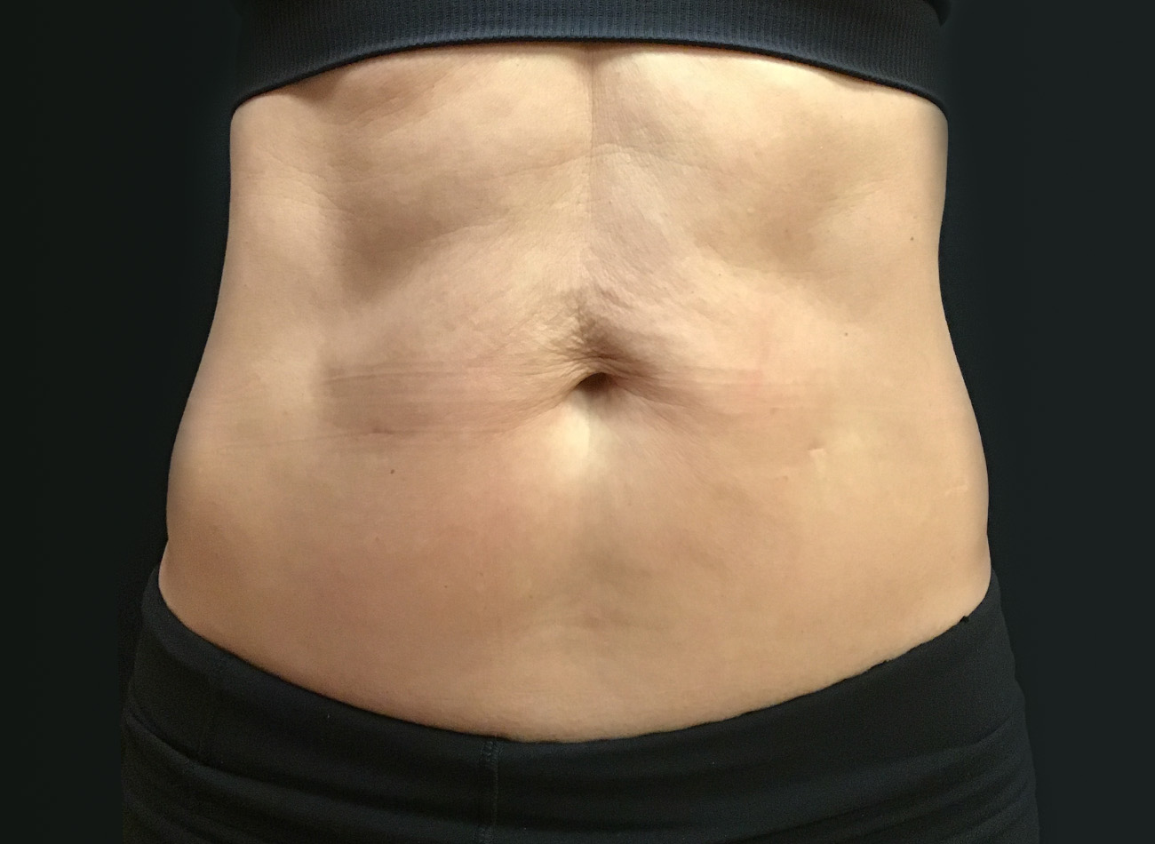 Patient #38810: EVOLVE for Skin Tightening Before Image