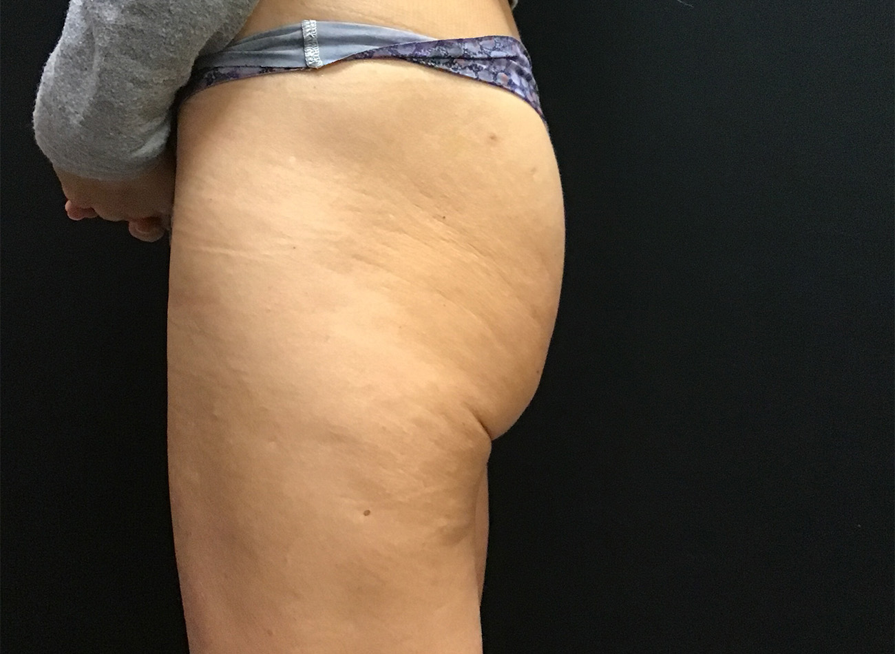 Patient #55565: EVOLVE for Cellulite Before Image