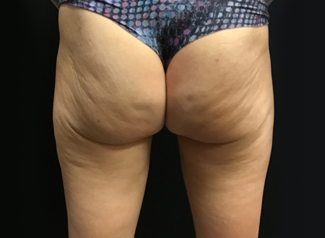 Patient #55565: EVOLVE for Cellulite Before Image