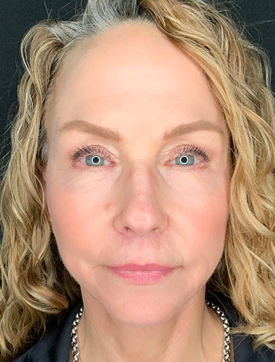 Patient #61136-1: Facelift with Necklift, Fat Injections, Lip Lift After Image