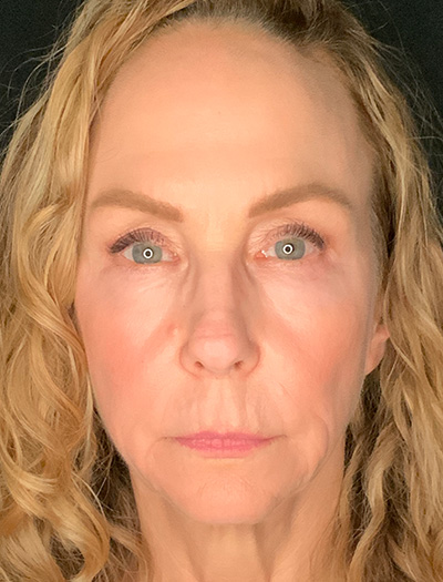 Patient #61136-1: Facelift with Necklift, Fat Injections, Lip Lift Before Image