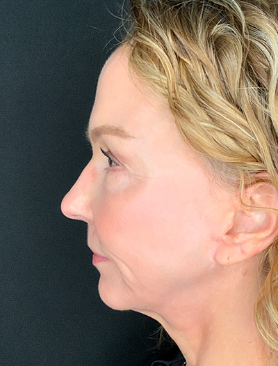 Patient #61136-1: Facelift with Necklift, Fat Injections, Lip Lift After Image