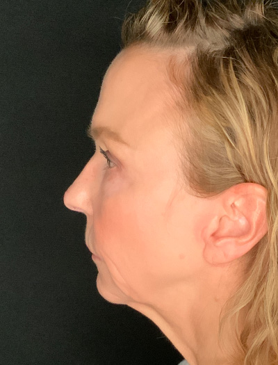 Patient #61136-1: Facelift with Necklift, Fat Injections, Lip Lift Before Image