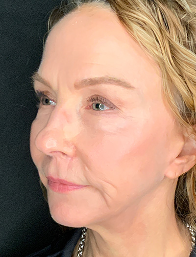 Patient #61136-1: Facelift with Necklift, Fat Injections, Lip Lift After Image