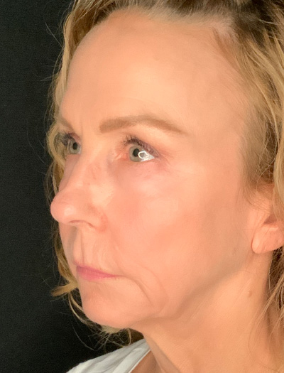 Patient #61136-1: Facelift with Necklift, Fat Injections, Lip Lift Before Image