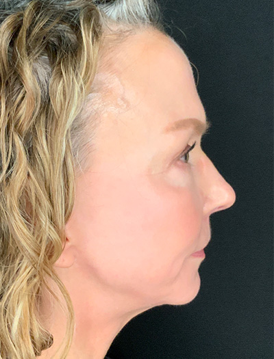 Patient #61136-1: Facelift with Necklift, Fat Injections, Lip Lift After Image