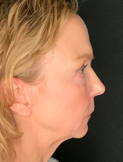 Patient #61136-1: Facelift with Necklift, Fat Injections, Lip Lift Before Image