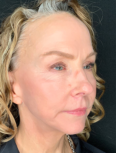Patient #61136-1: Facelift with Necklift, Fat Injections, Lip Lift After Image