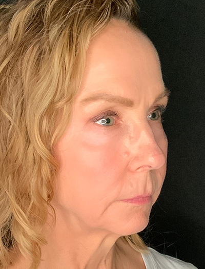 Patient #61136-1: Facelift with Necklift, Fat Injections, Lip Lift Before Image