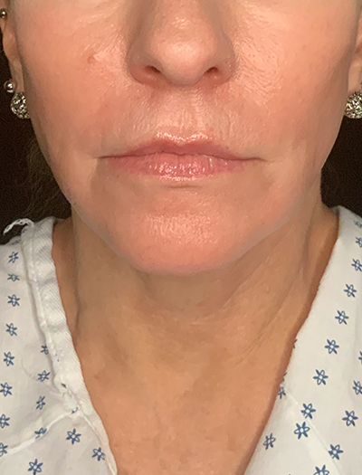 Patient #13826: Facelift After Image