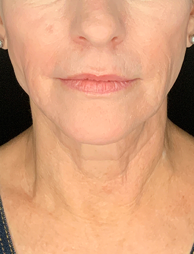 Patient #13826: Facelift Before Image
