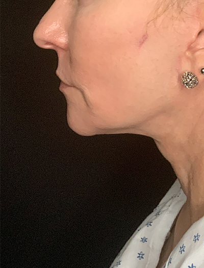 Patient #13826: Facelift After Image