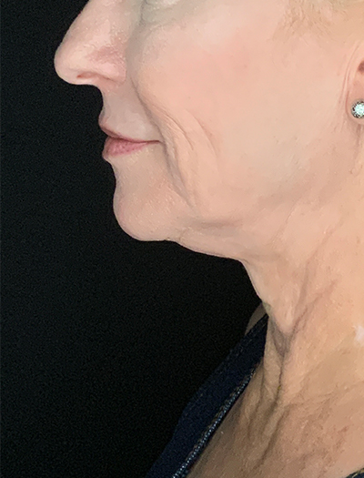Patient #13826: Facelift Before Image