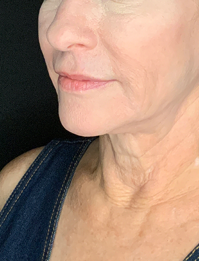 Patient #13826: Facelift Before Image