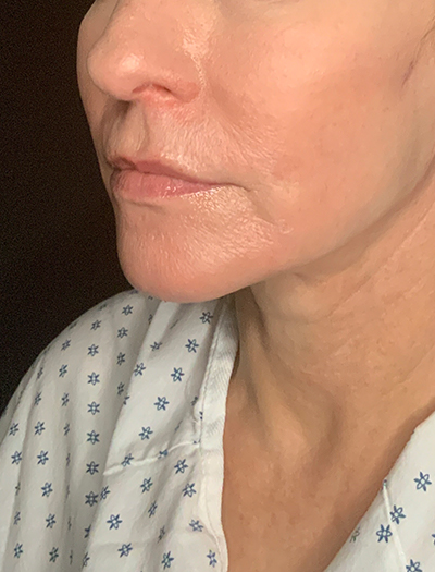 Patient #13826: Facelift After Image