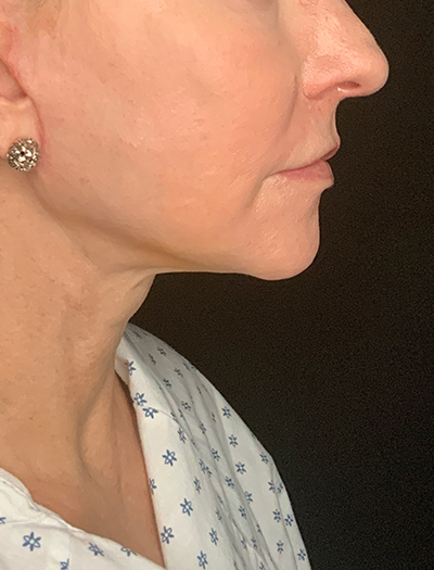 Patient #13826: Facelift After Image