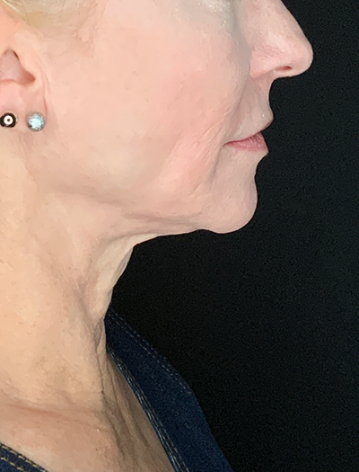 Patient #13826: Facelift Before Image